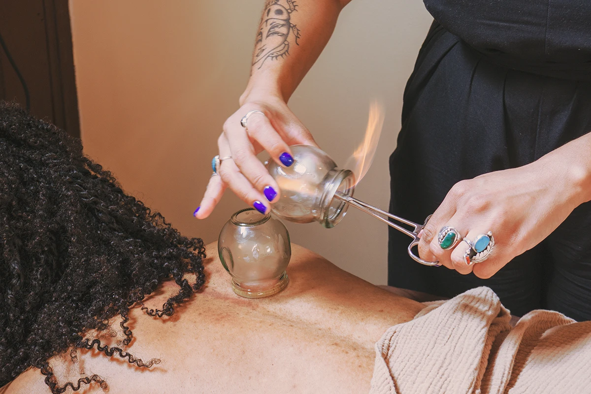 Fire cupping therapy session at Sanctuary Health in Chicago