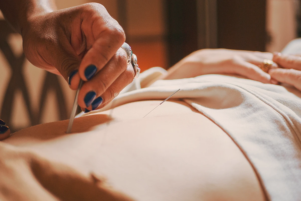 Licensed acupuncturist providing acupuncture therapy in Chicago at Sanctuary Health