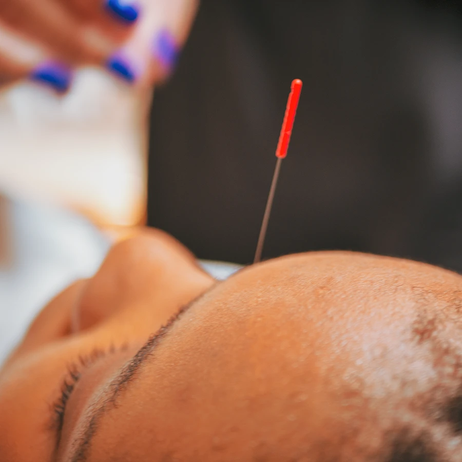Acupuncture needle placement during a therapeutic treatment session.