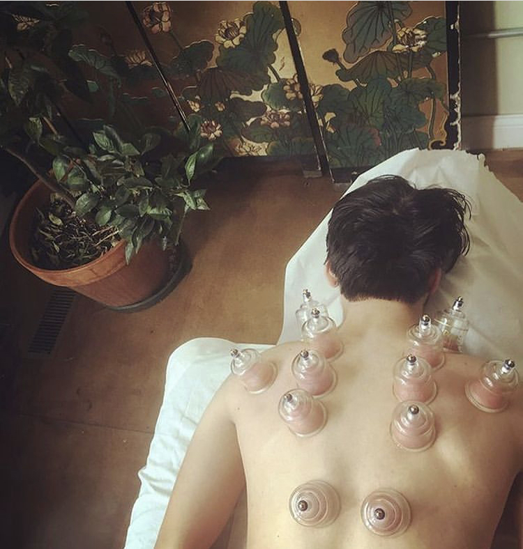 Cupping therapy session with glass cups applied to a patient’s back for pain relief.